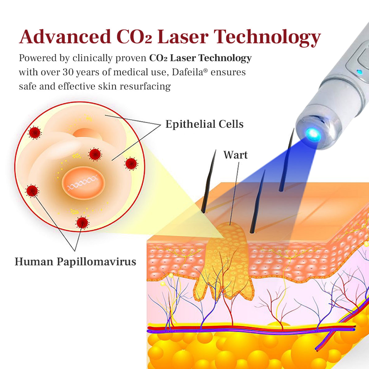 DAFEILA® LumeSkin Mole and Wart Removal Laser Pen