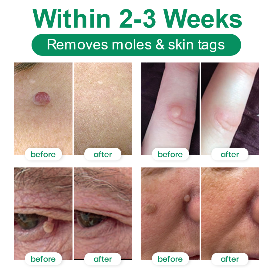 Lyyeto® Herdle Shot Spot & Mole Correct Serum ACE