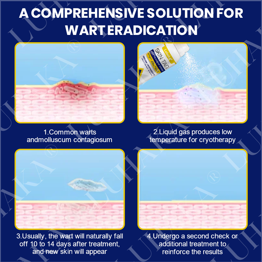 LUHAKA® SKIN TAG CRYO TREATMENT SPRAY🔷_Ultra1
