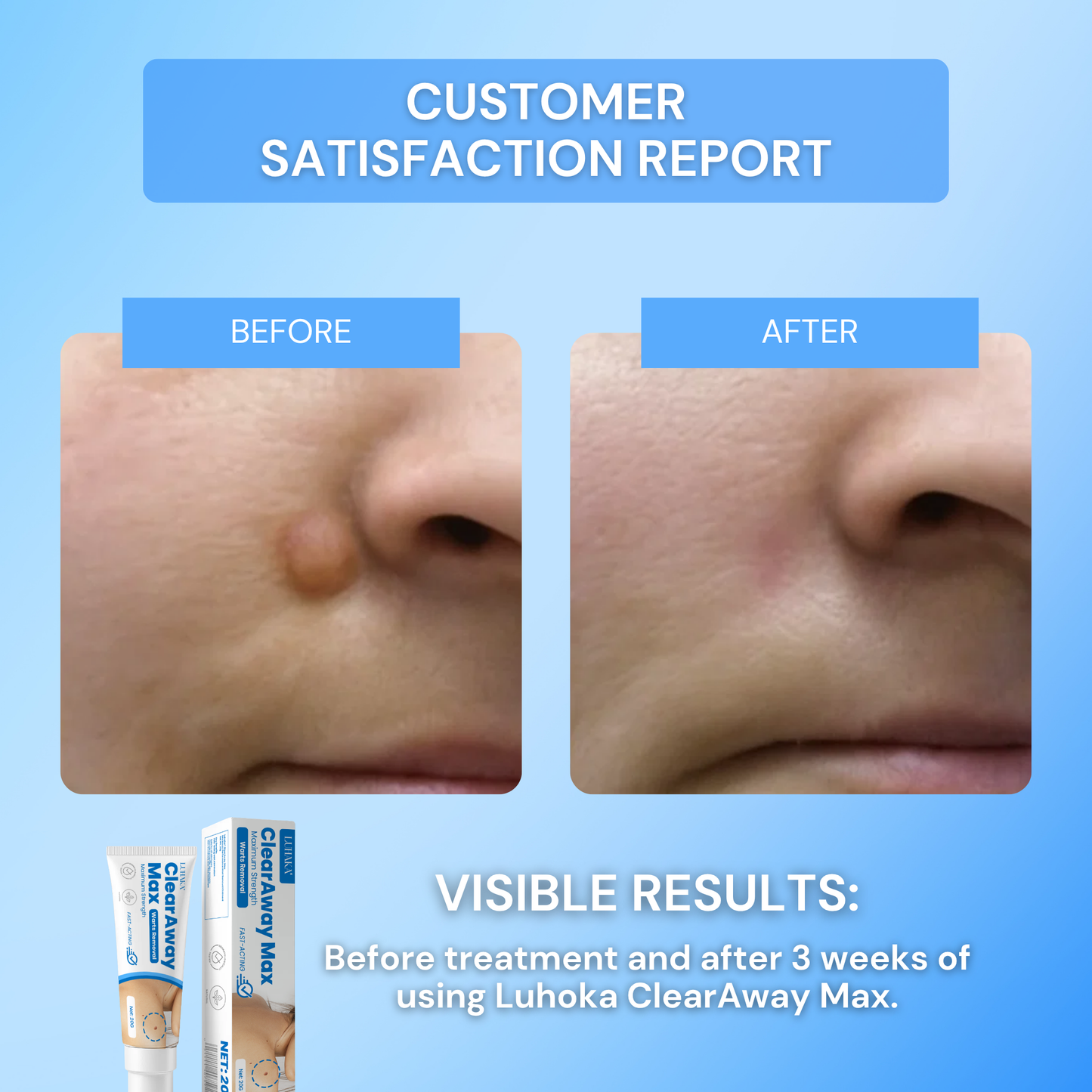 Luhaka® Clear Away Wax Warts Removal ACE 4