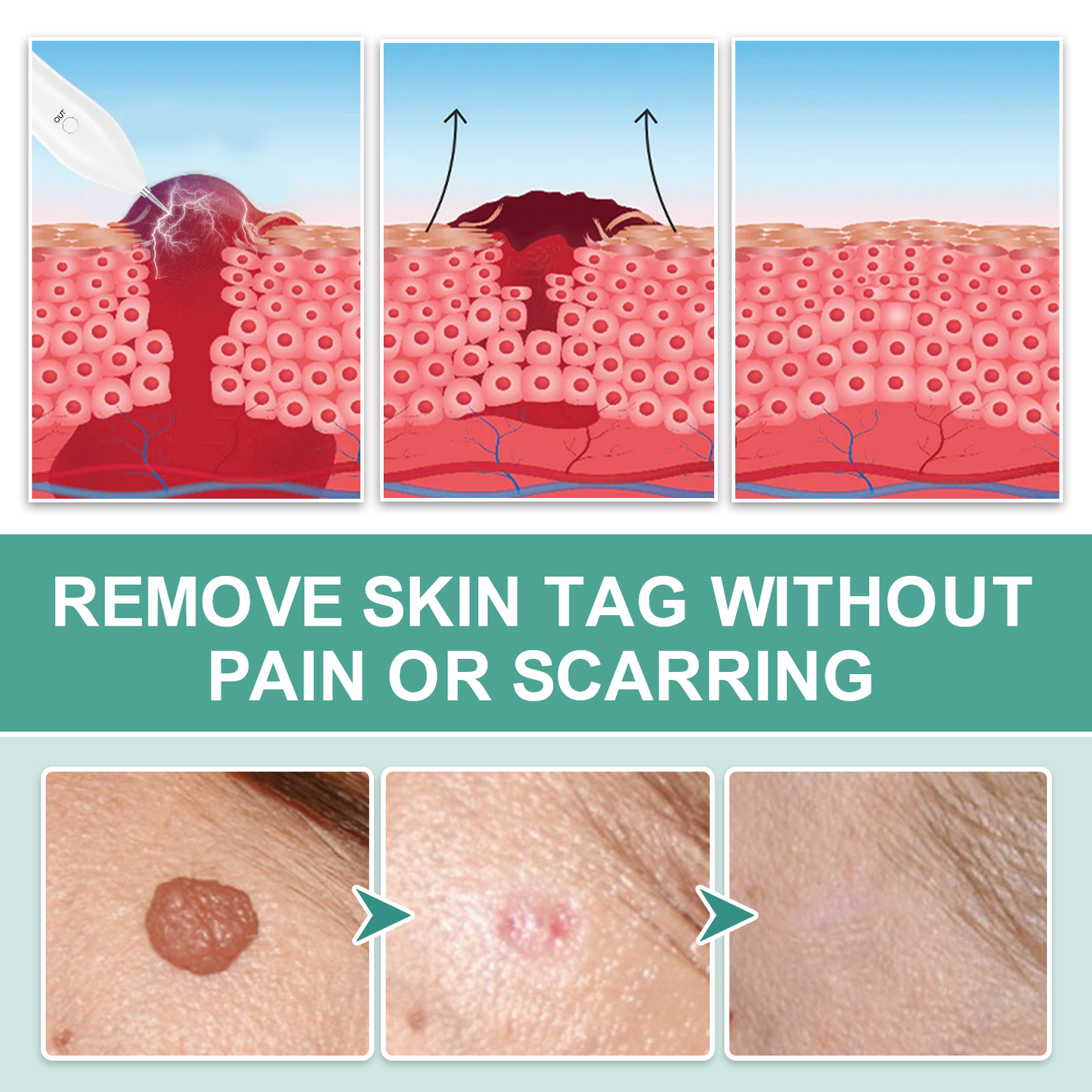 Dafeila® Advanced Plasma Laser Spot Cleaning Pen 🔥