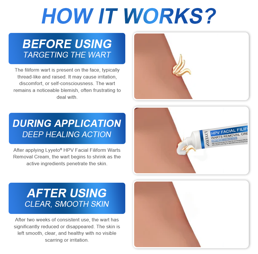 LYYETO® HPV Facial Filiform Warts Removal Cream ACE