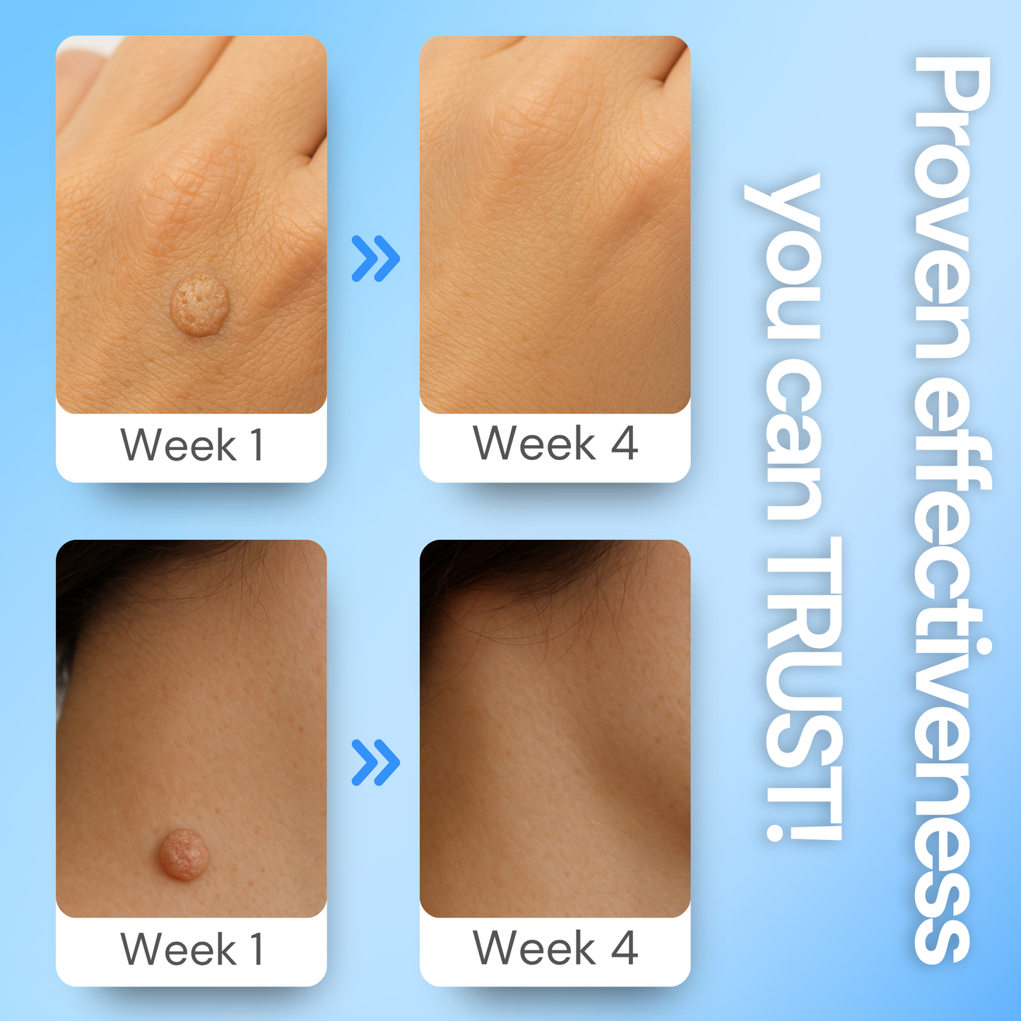 Luhaka® Clear Away Wax Warts Removal ACE 4