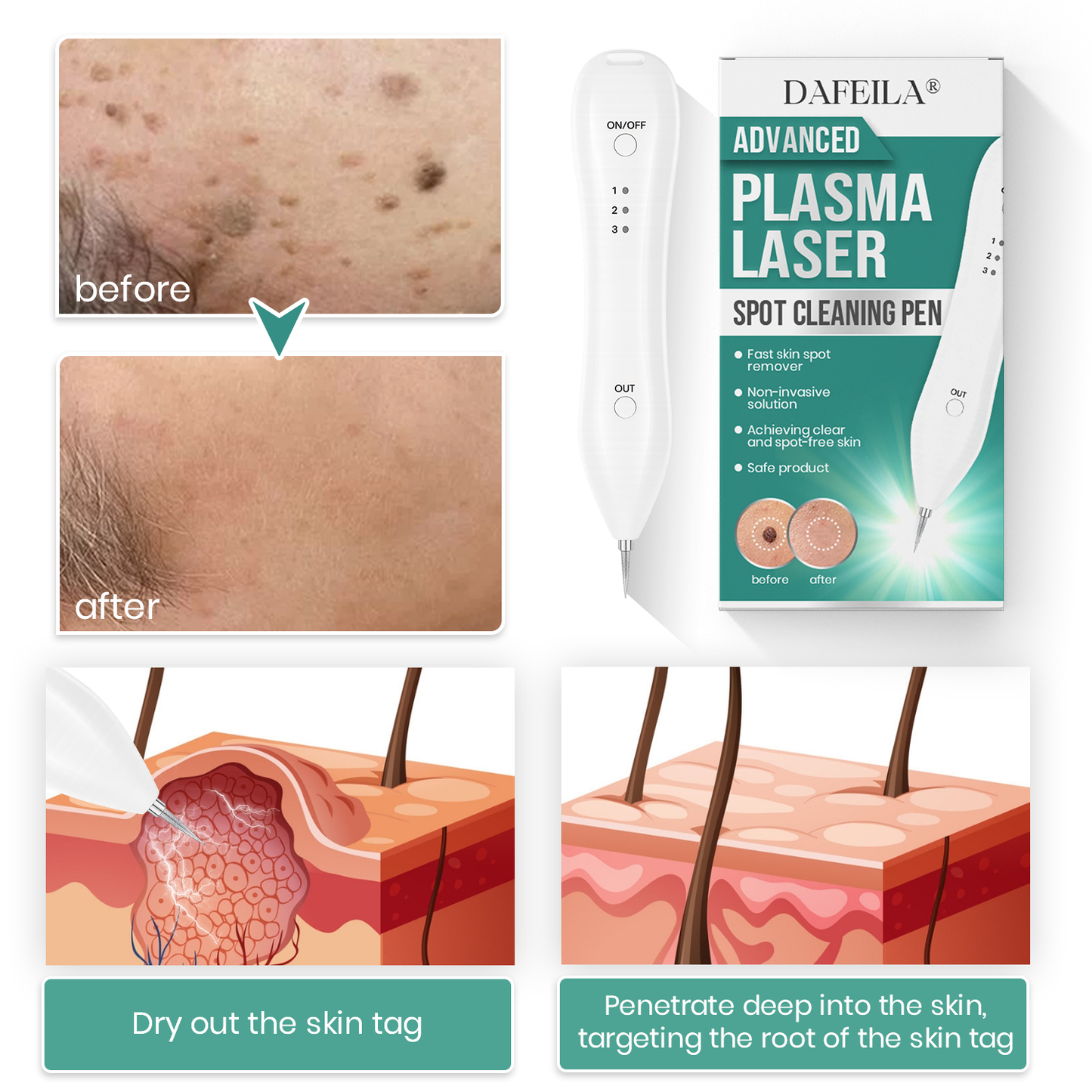 Dafeila® Advanced Plasma Laser Spot Cleaning Pen 🔥