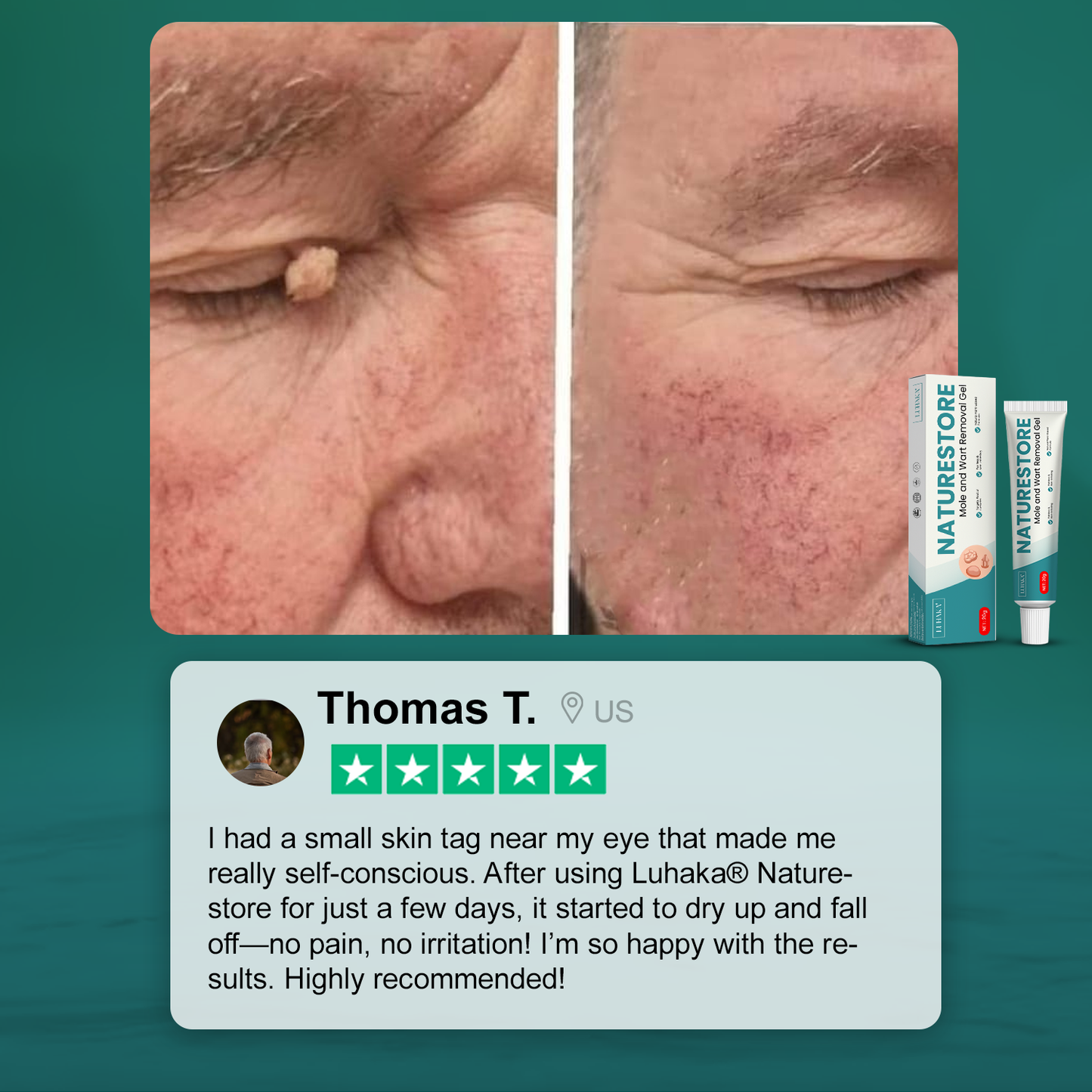 Luhaka® Naturestore Mole and Wart Removal Gel