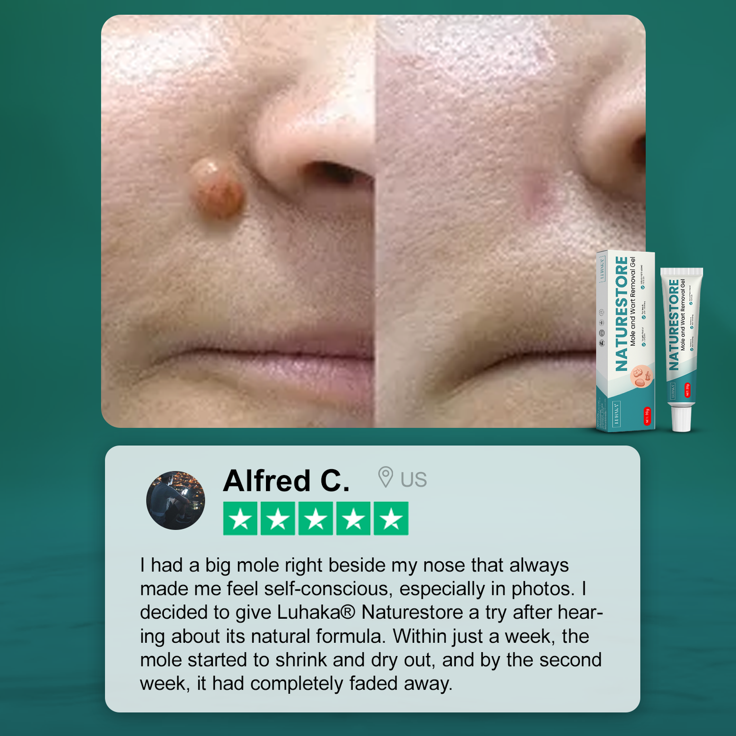 Luhaka® Naturestore Mole and Wart Removal Gel