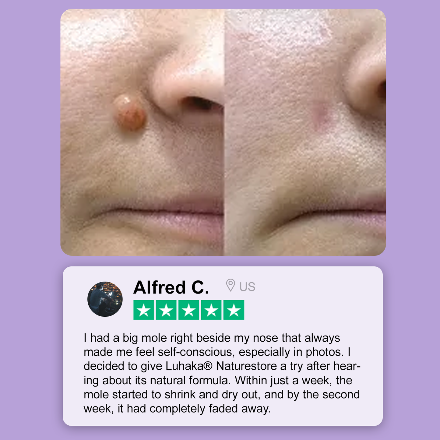 Luhaka® Naturestore Wart and Mole Removal Gel