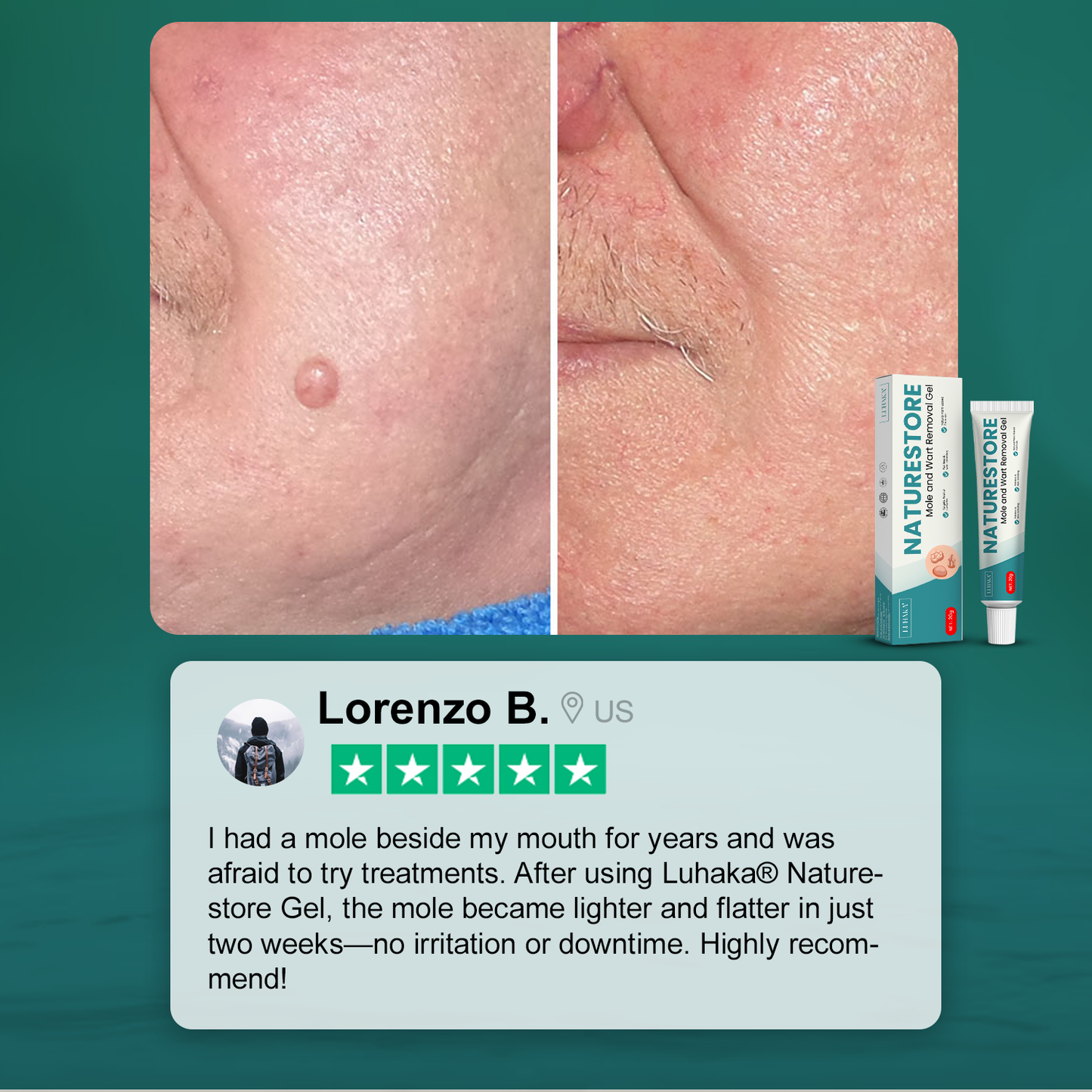 Luhaka® Naturestore Mole and Wart Removal Gel