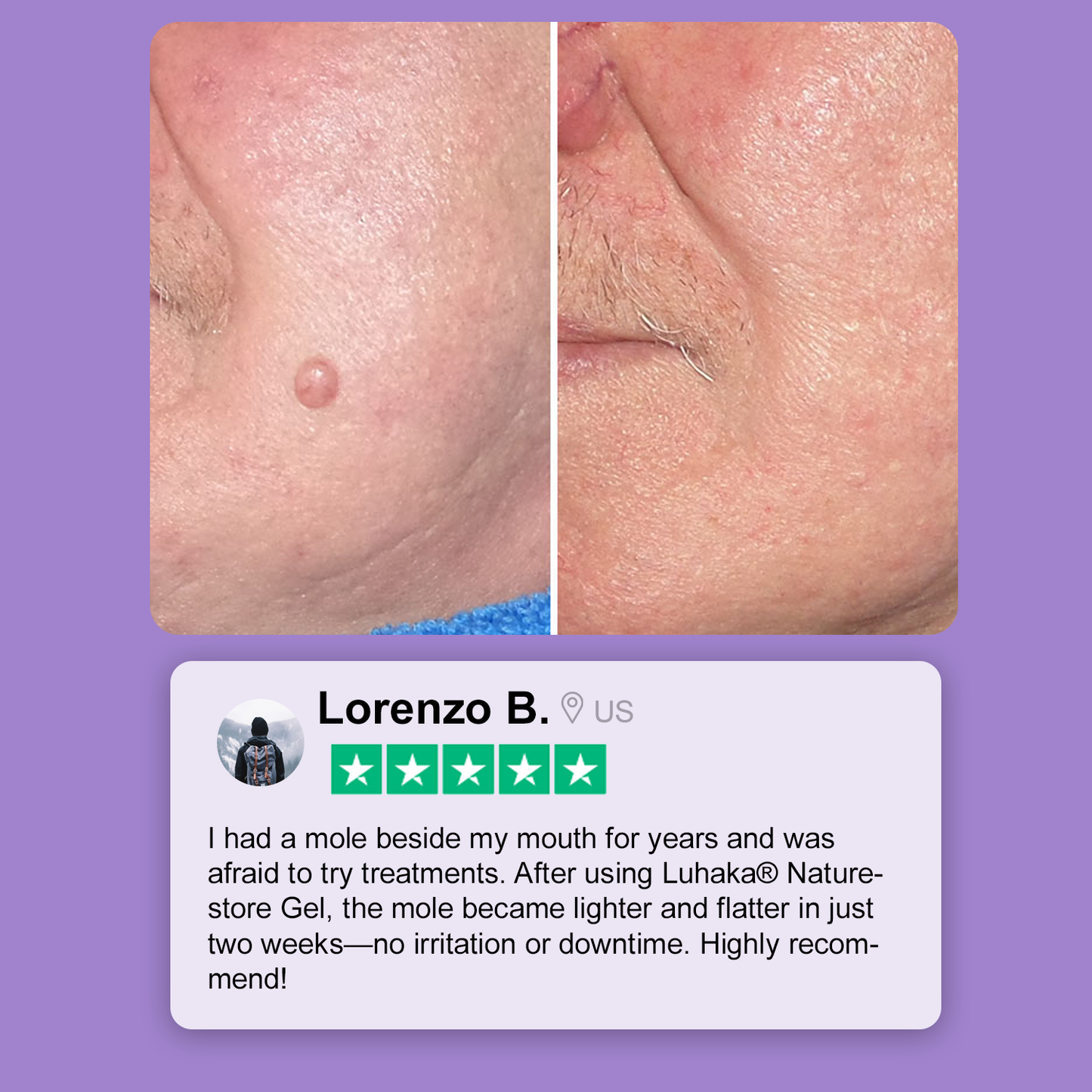 Luhaka® Naturestore Wart and Mole Removal Gel