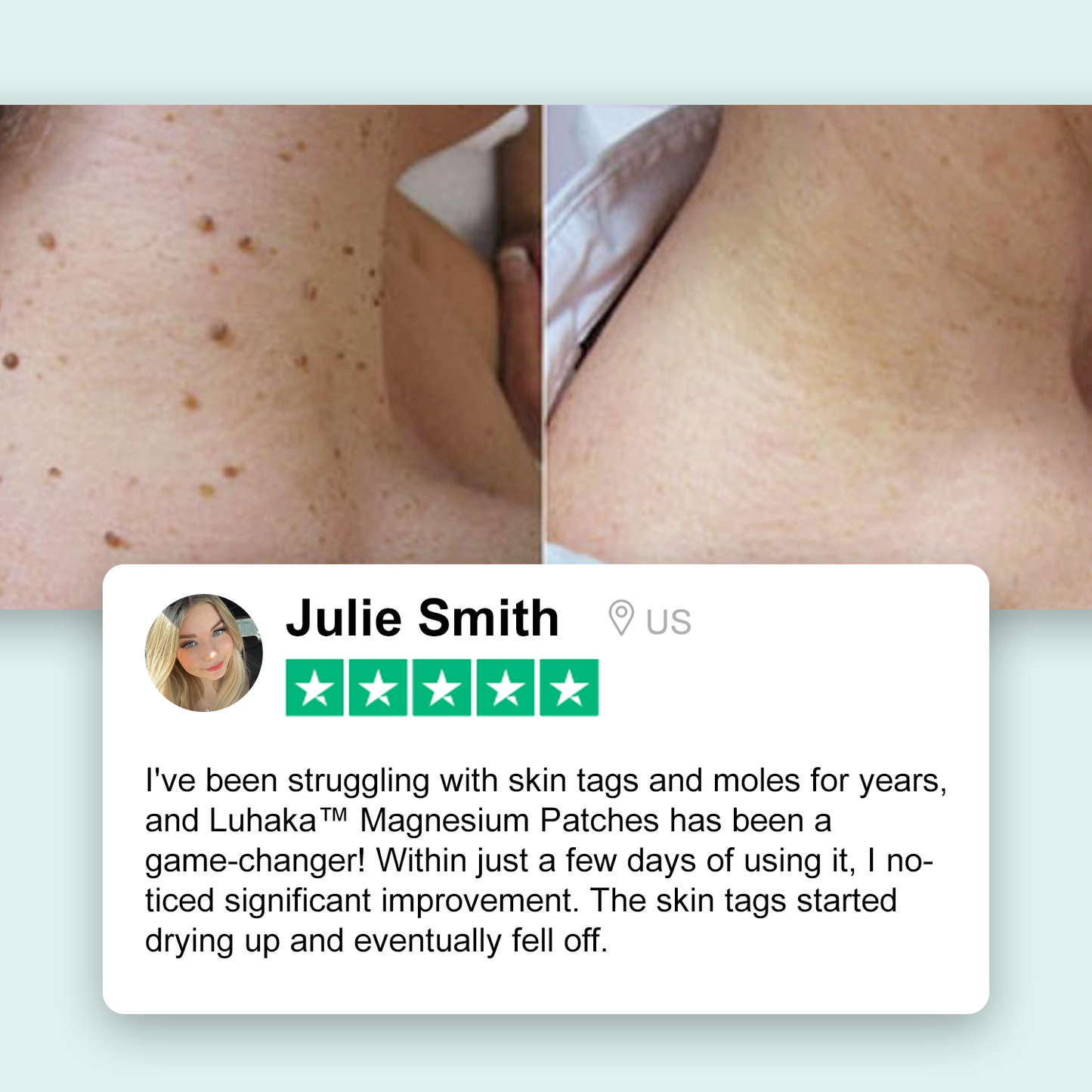 Luhaka® Magnesium Micro-pin Wart Removal Patch_Ultra01