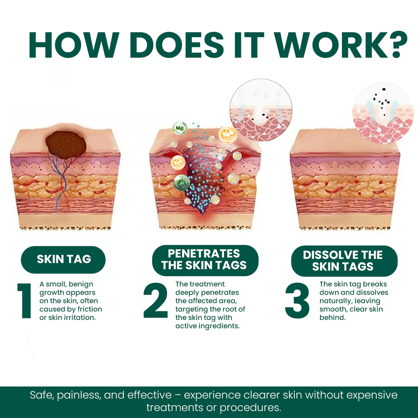 Luhaka® Magnesium Micro-pin Wart Removal Patch_Ultra01