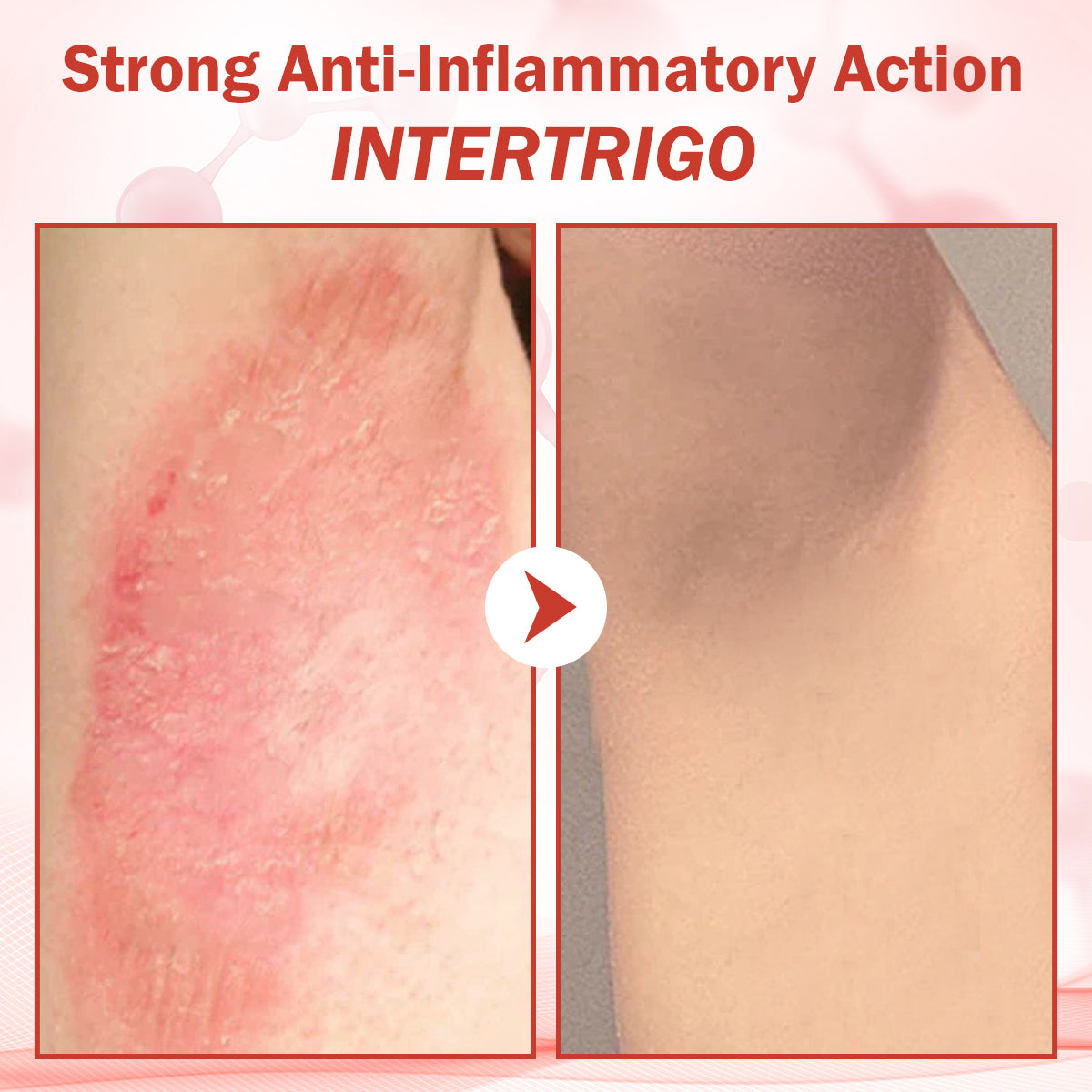 Luhaka® PureSkin Microneedle Botanic Skin Tag Removal Patch ACE 1