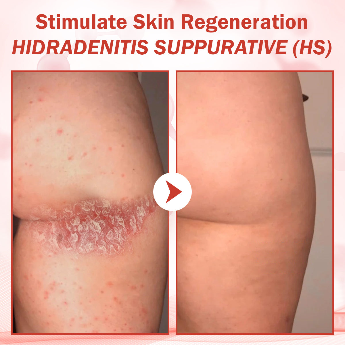 Luhaka® PureSkin Microneedle Botanic Skin Tag Removal Patch ACE 1