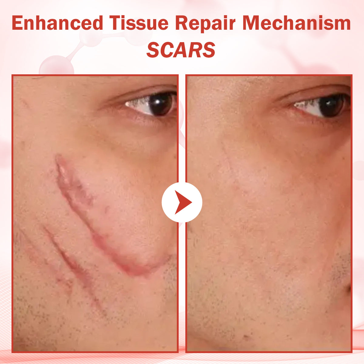 Luhaka® PureSkin Microneedle Botanic Skin Tag Removal Patch ACE 1