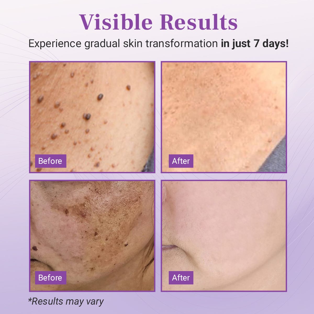 Luhaka® DermaClear Mole and Dark Spot Removal Bio-Gel_Ultra01