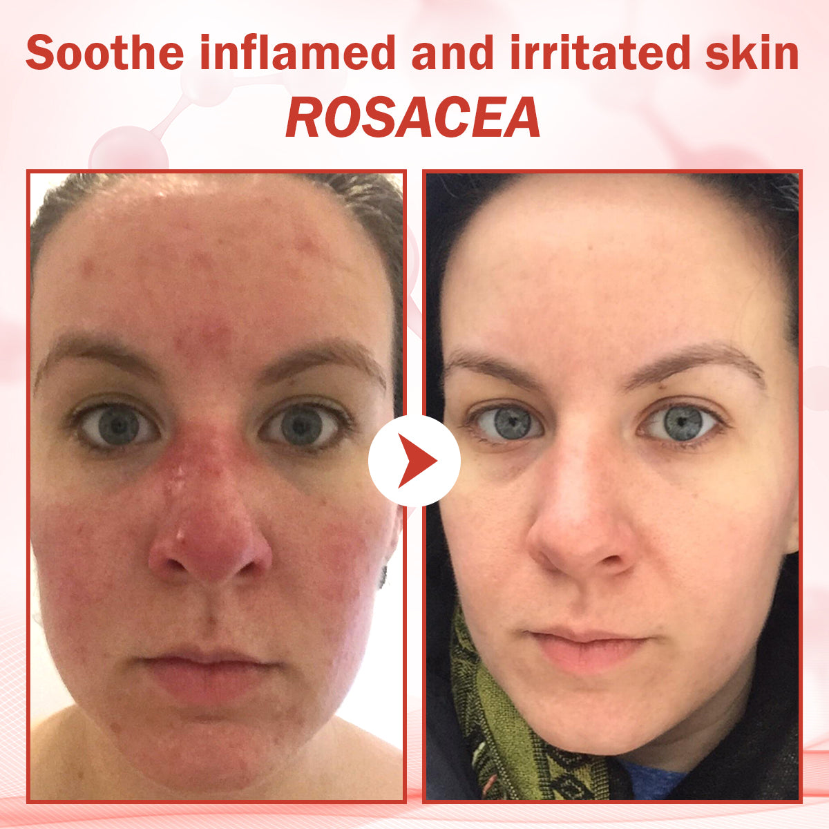 Luhaka® PureSkin Microneedle Botanic Skin Tag Removal Patch ACE 1