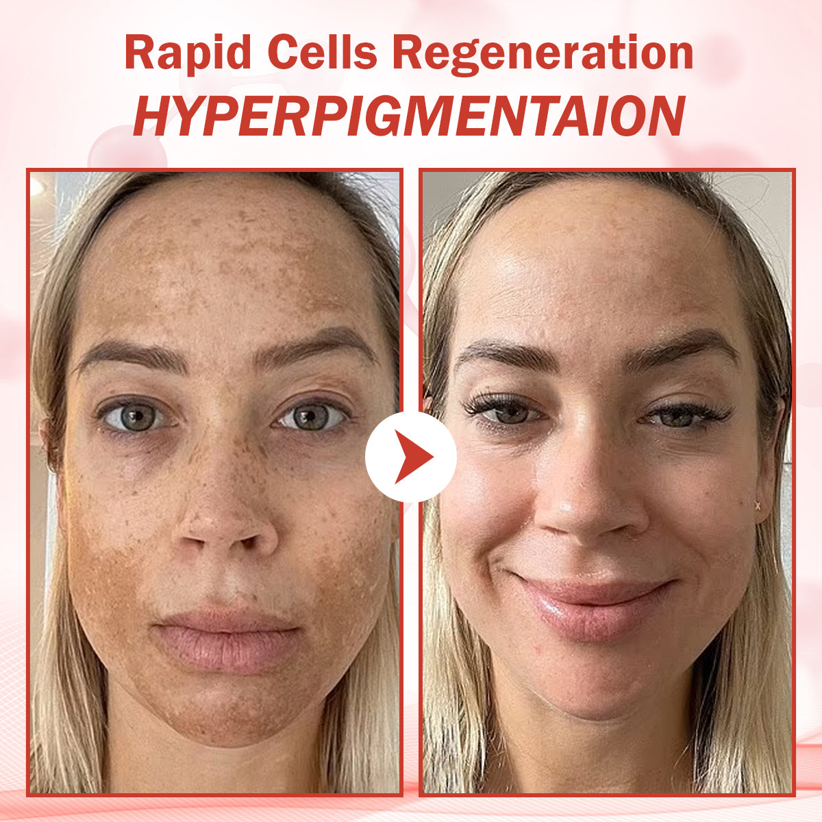 Luhaka® PureSkin Microneedle Botanic Skin Tag Removal Patch ACE 1