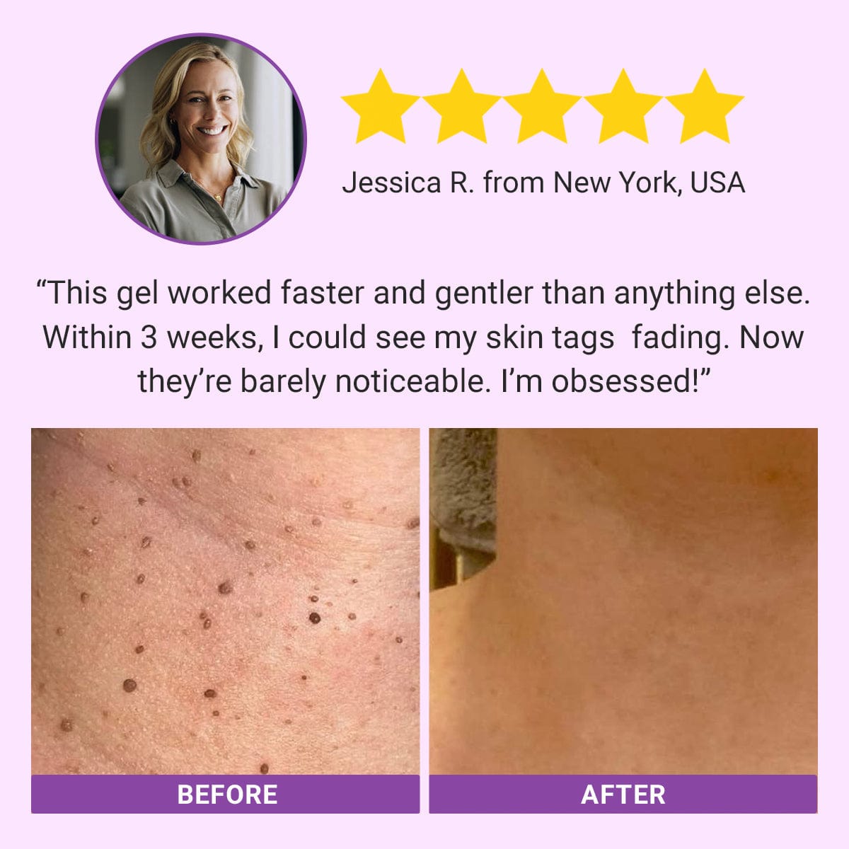 Luhaka® DermaClear Mole and Dark Spot Removal Bio-Gel_Ultra01