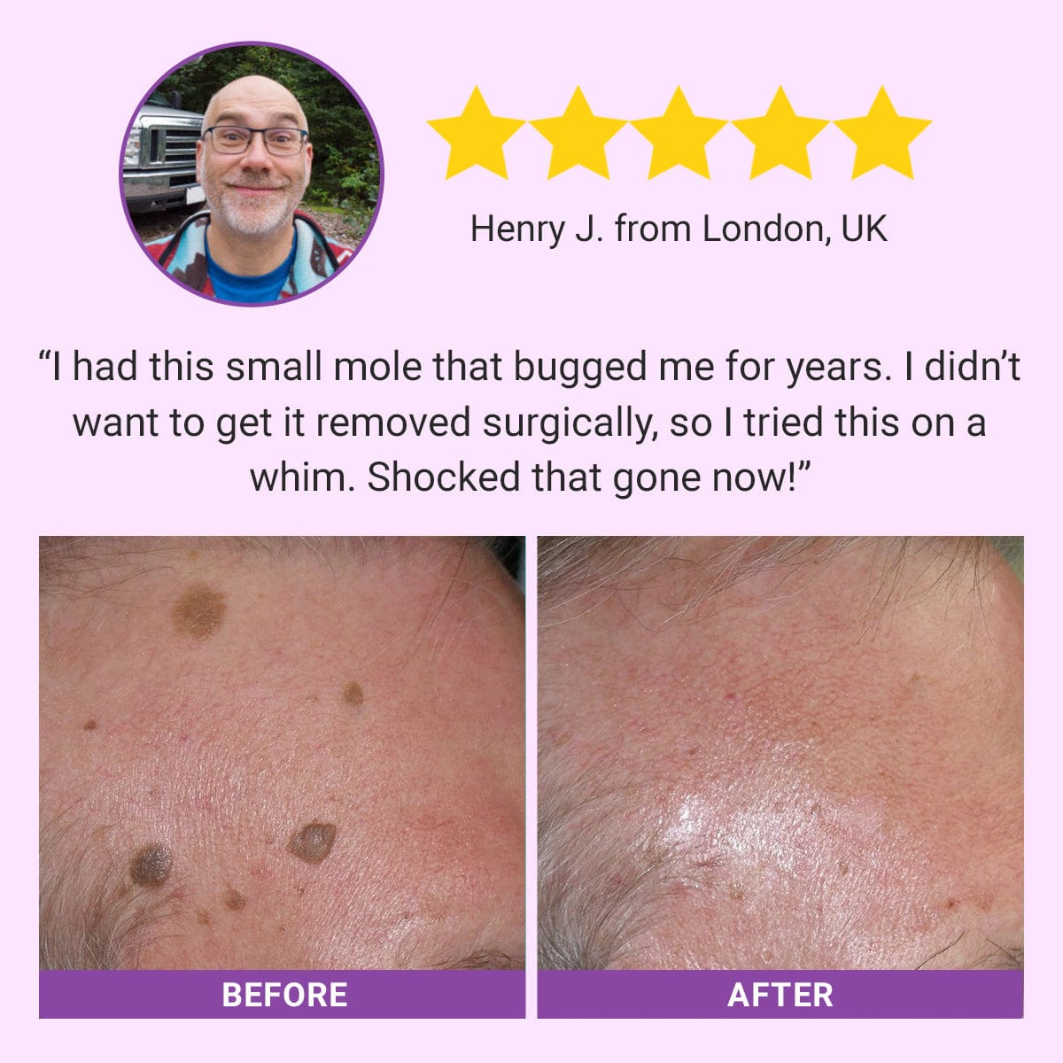 Luhaka® DermaClear Mole and Dark Spot Removal Bio-Gel_Ultra01