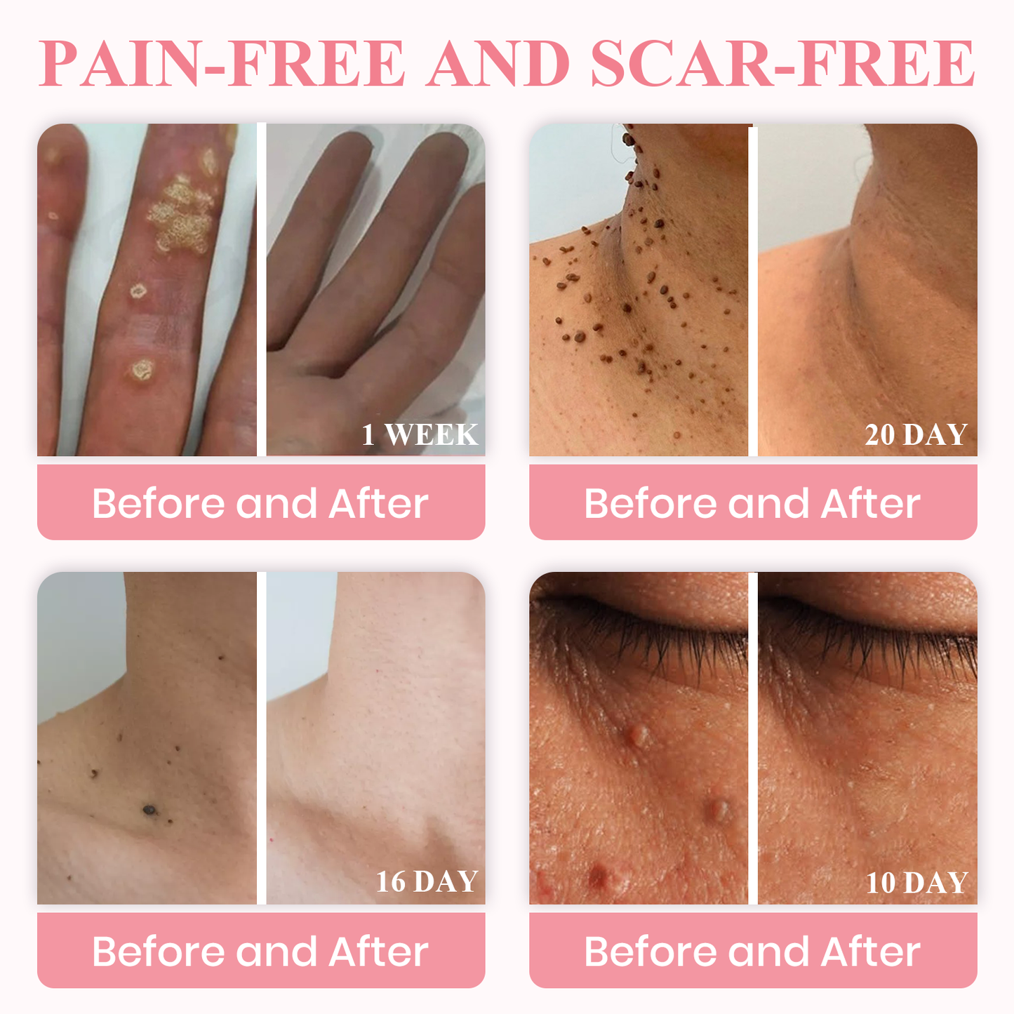 LUHAKA® Dual Acid Wart & Mole Removal Serum ACE