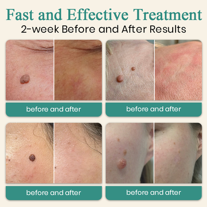 DAFEILA® LumeSkin Mole and Wart Instant Removal Laser Pen_Ultra03