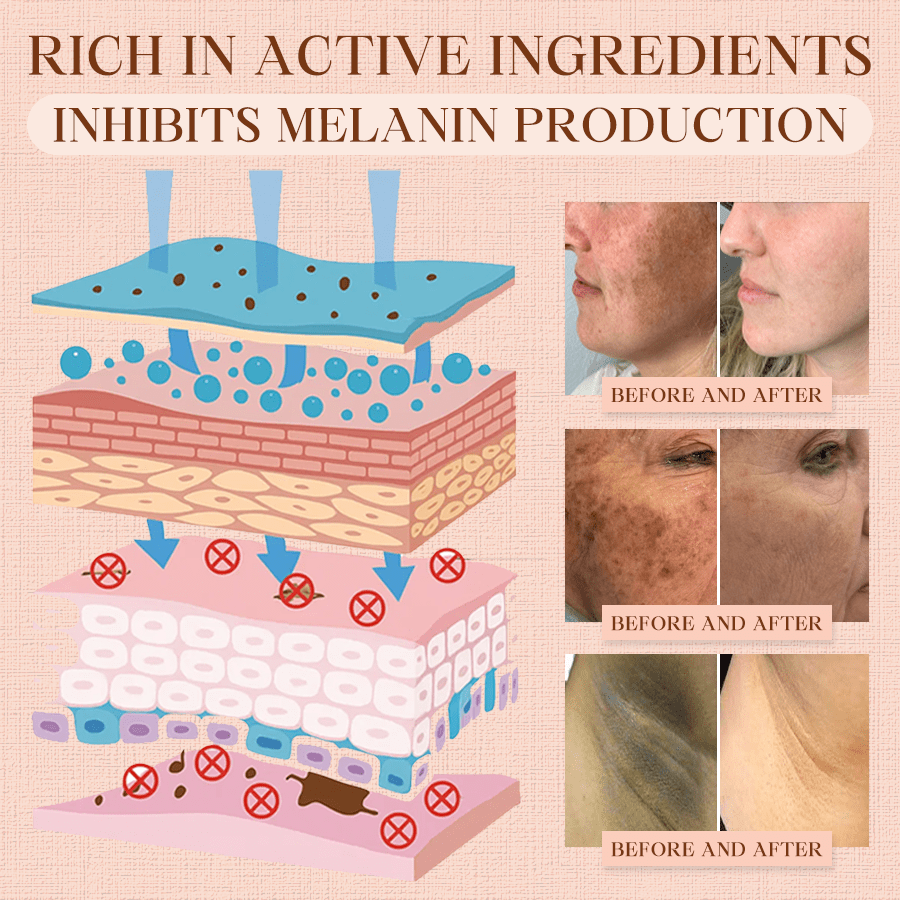 Luhaka® Purifying Exfoliating Gel ACE 13 for Acanthosis Nigricans, Exfoliation, Dark Spots, Skin Tags, and Eczema