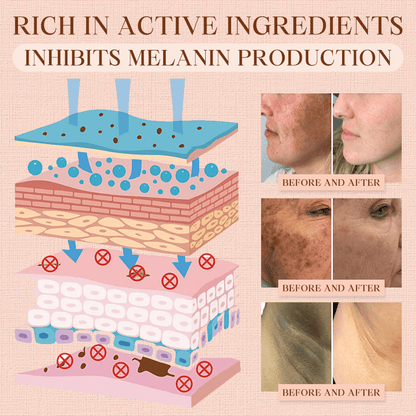 Luhaka® Purifying Exfoliating Gel ACE 13 for Acanthosis Nigricans, Exfoliation, Dark Spots, Skin Tags, and Eczema