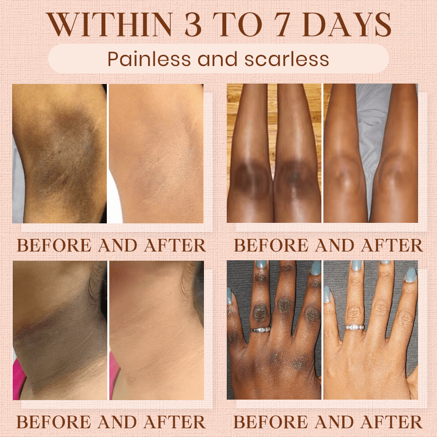 Luhaka® Purifying Exfoliating Gel ACE 13 for Acanthosis Nigricans, Exfoliation, Dark Spots, Skin Tags, and Eczema