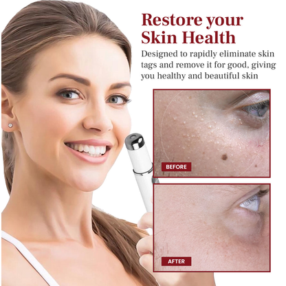 DAFEILA® LumeSkin Mole and Wart Removal Laser Pen