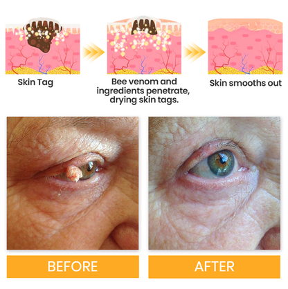 LUHAKA® BeeClear MicroDart Patch