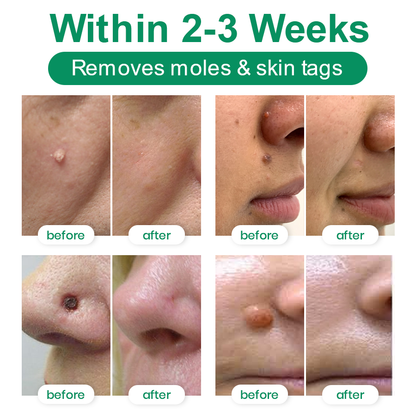 Lyyeto® Herdle Shot Spot & Mole Correct Serum ACE