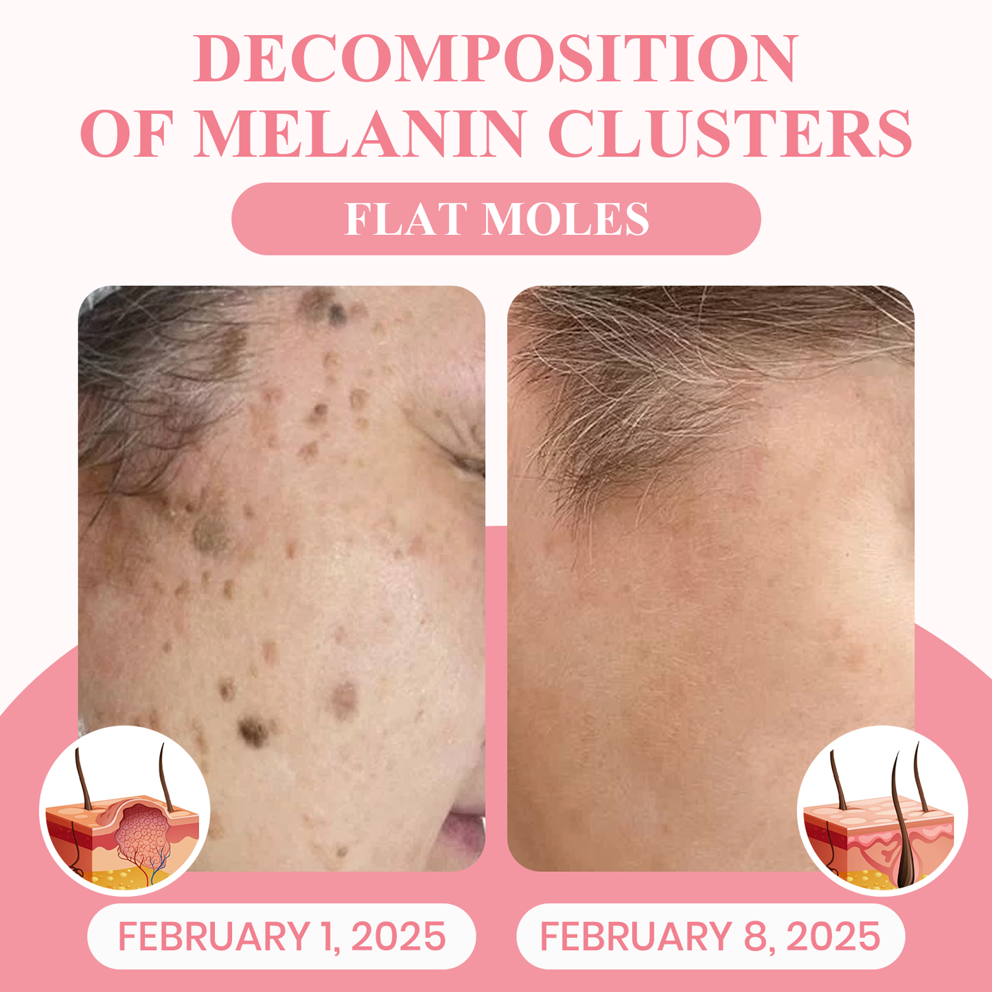 LUHAKA® Dual Acid Wart & Mole Removal Serum ACE