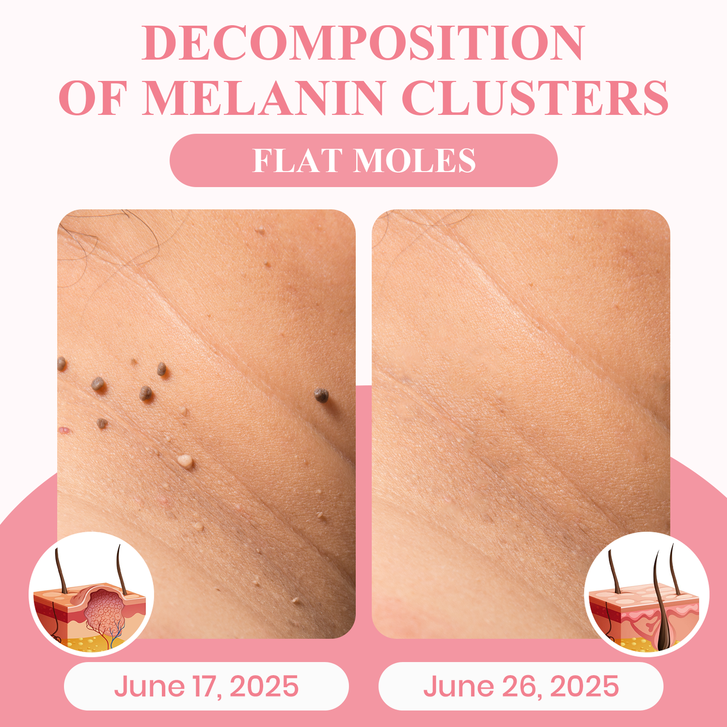 LUHAKA® Dual Acid Wart & Mole Removal Serum ACE