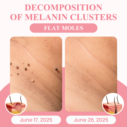 LUHAKA® Dual Acid Wart & Mole Removal Serum ACE