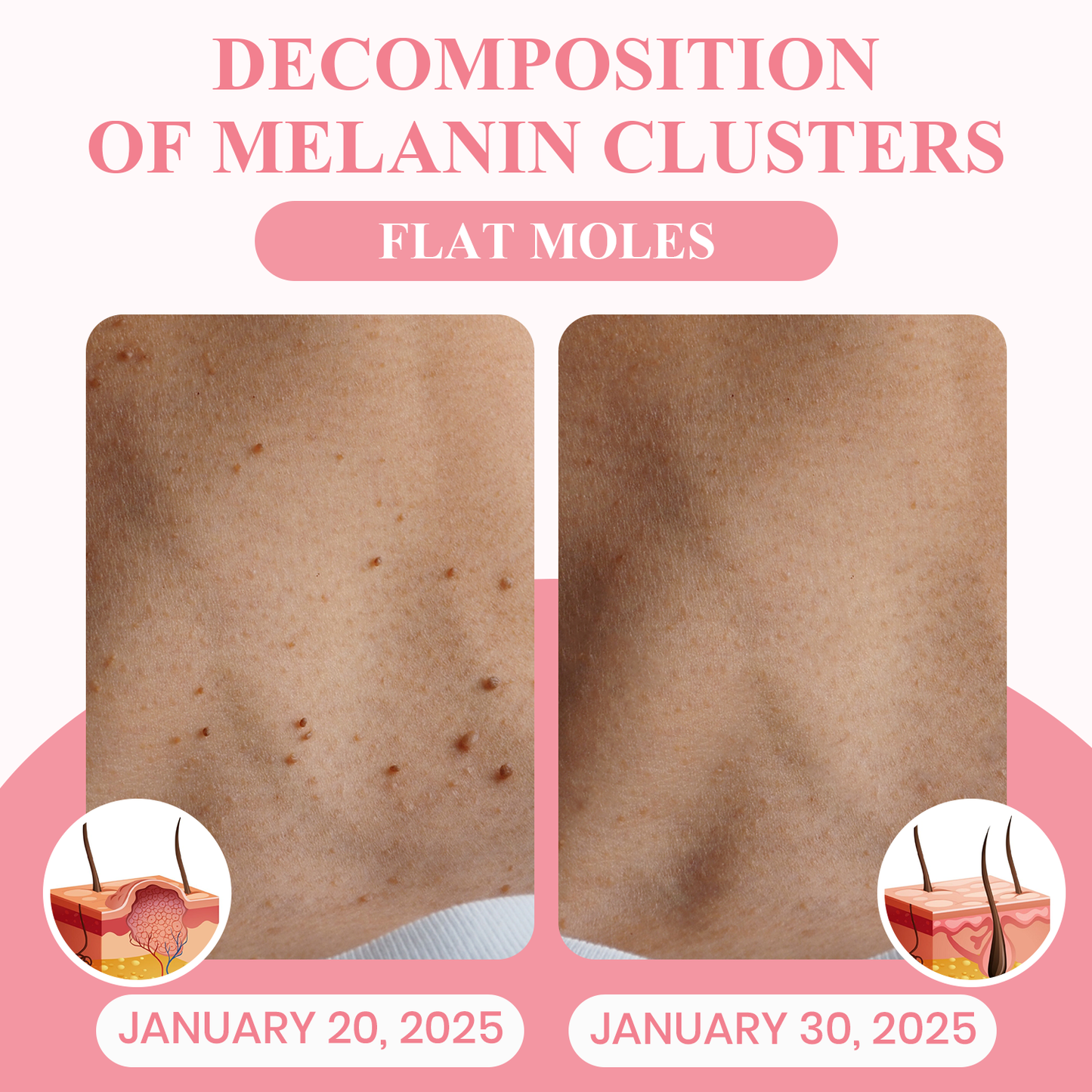 LUHAKA® Dual Acid Wart & Mole Removal Serum ACE