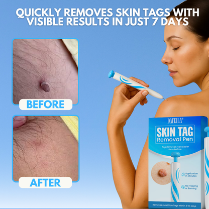 Dafeila® Skin Tag Removal Pen_Ultra02