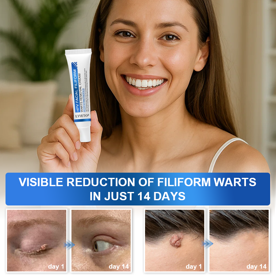 LYYETO® HPV Facial Filiform Warts Removal Cream