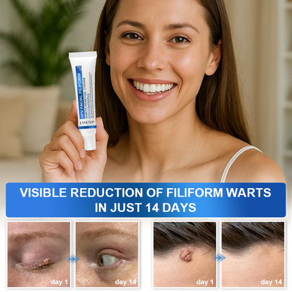 LYYETO® HPV Facial Filiform Warts Removal Cream