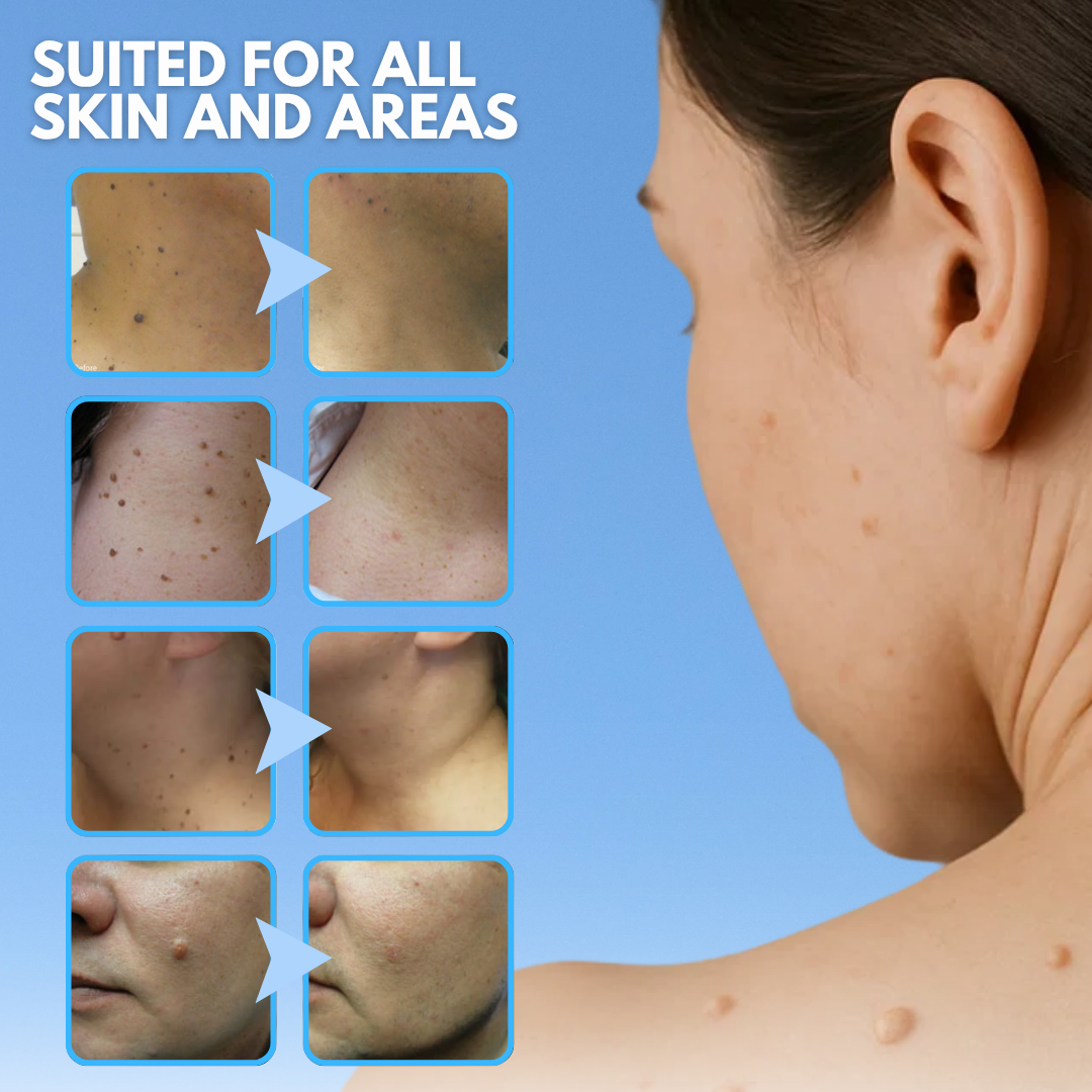 Dafeila® Skin Tag Removal Pen_Ultra02