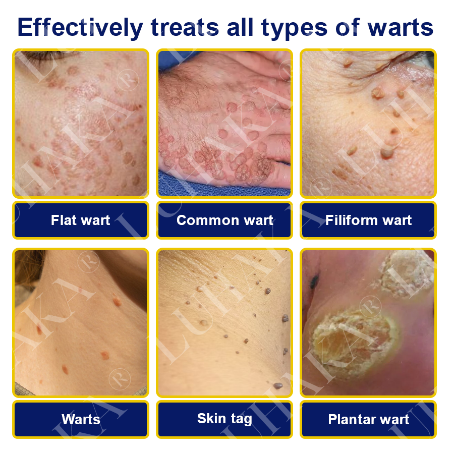 LUHAKA® SKIN TAG CRYO TREATMENT SPRAY ACE