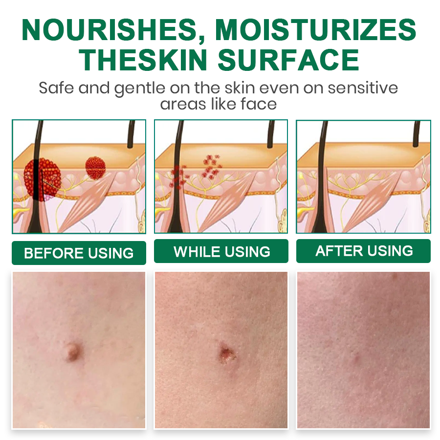 Lyyeto® Herdle Shot Spot & Mole Correct Serum ACE