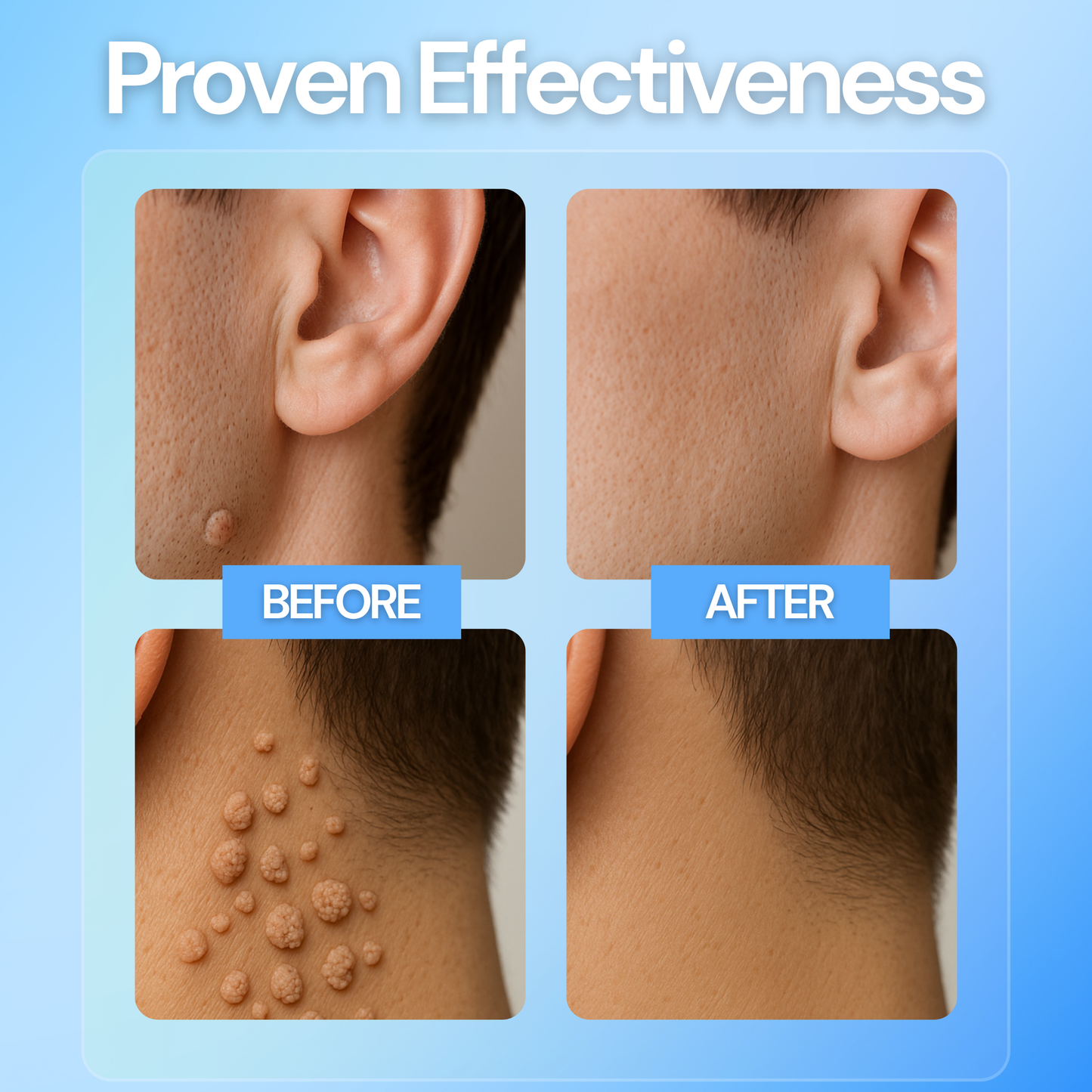 Luhaka® Clear Away Wax Warts Removal