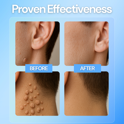 Luhaka® Clear Away Wax Warts Removal