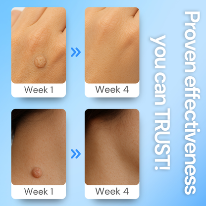 Luhaka® Clear Away Wax Warts Removal
