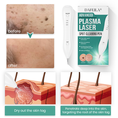 Dafeila® Advanced Plasma Laser Spot Cleaning Pen