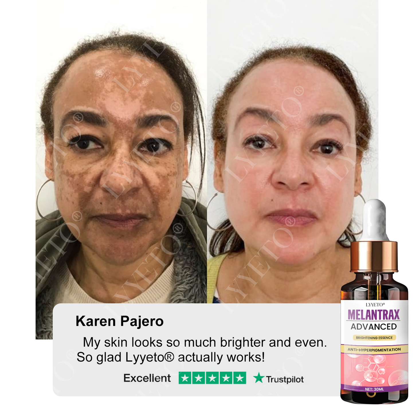 Lyyeto® MelantraX Advanced Brightening Essence 🏆