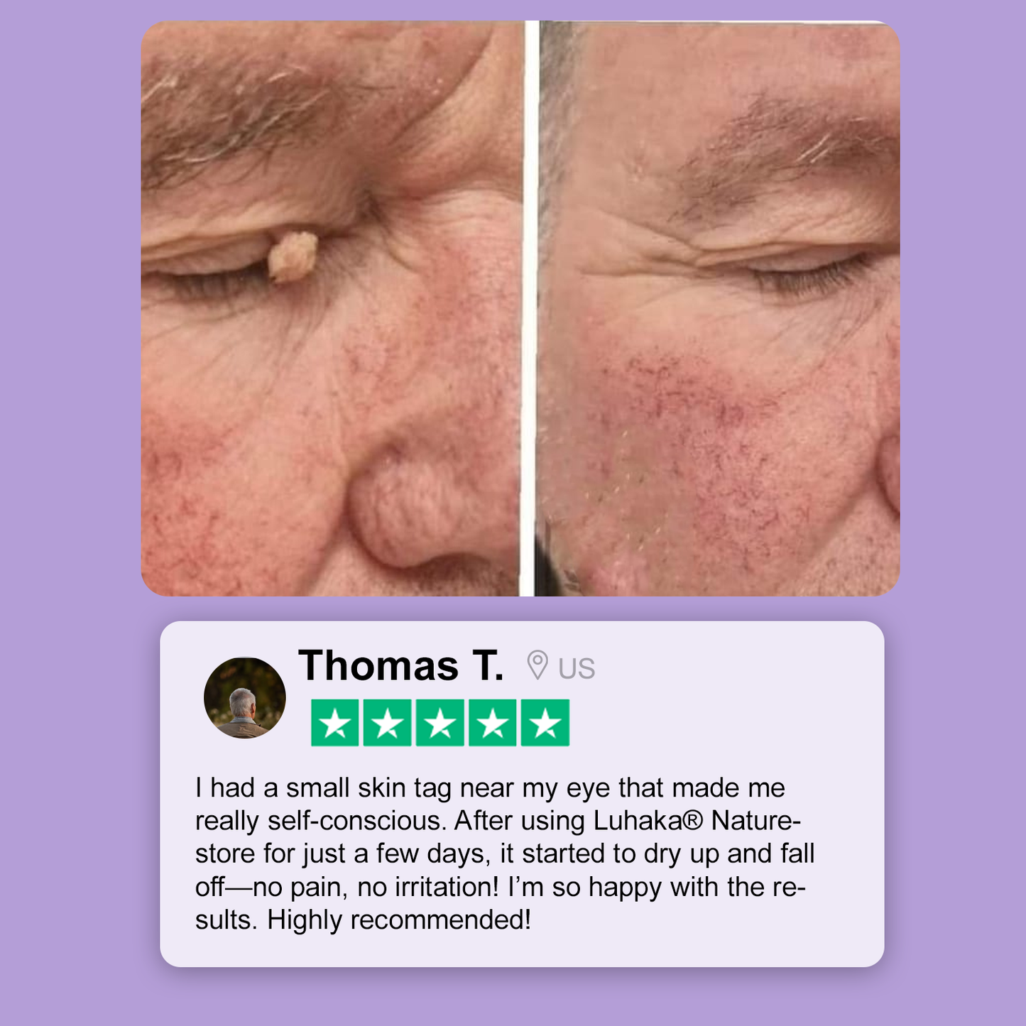 Luhaka® Naturestore Wart and Mole Removal Gel 🌟