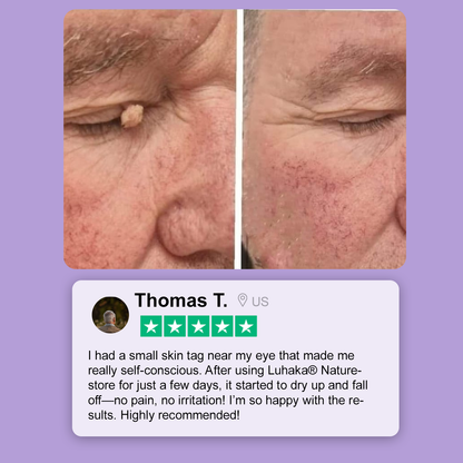 Luhaka® Naturestore Wart and Mole Removal Gel 🌟