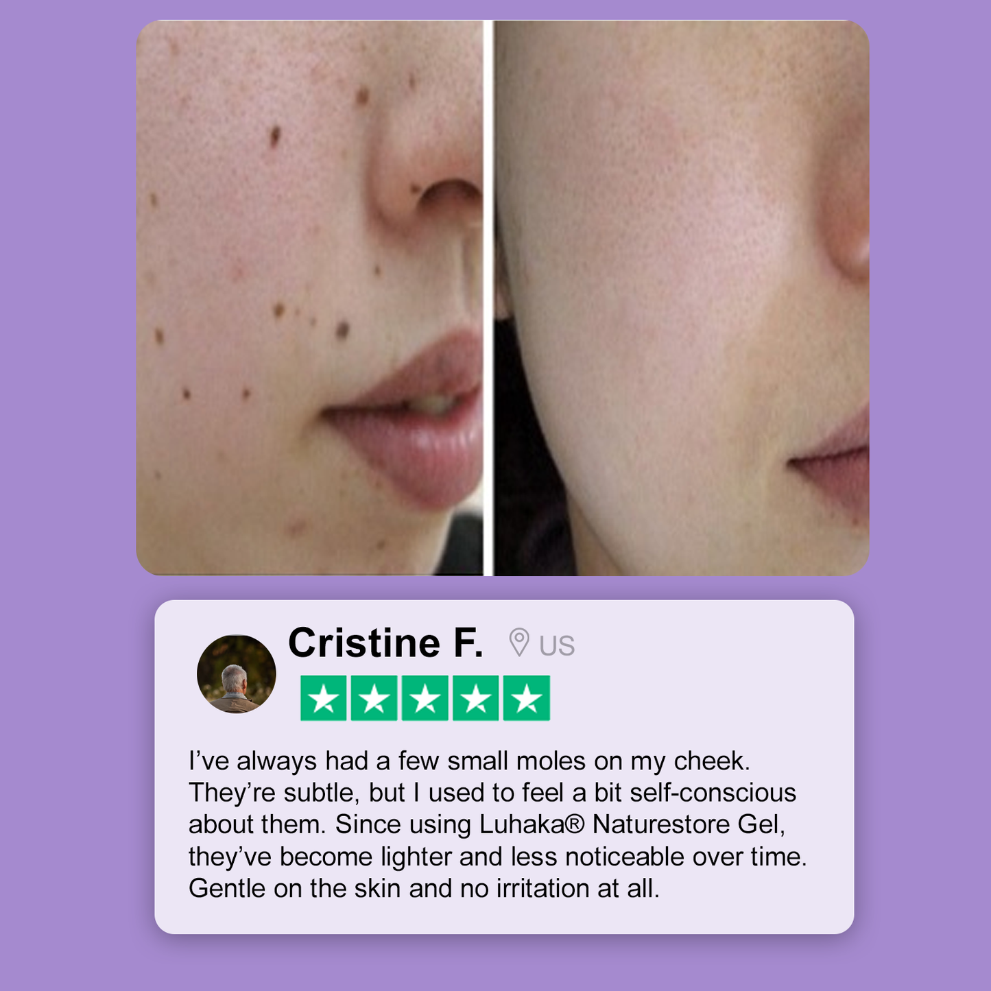 Luhaka® Naturestore Wart and Mole Removal Gel 🌟