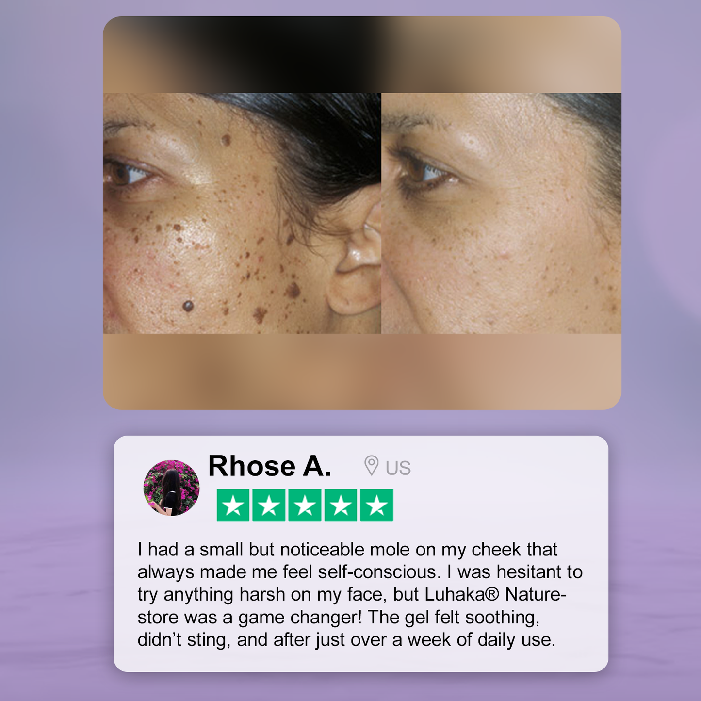 Luhaka® Naturestore Wart and Mole Removal Gel 🌟